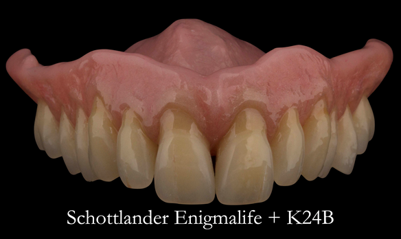 Figure 97 Mk 2 definitive denture finished - with characterisation