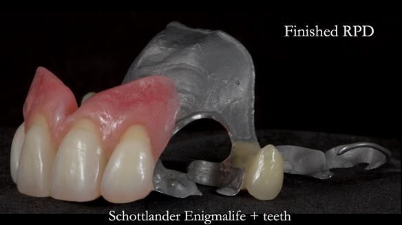 Newsletter 81 - Pam’s Story — how a partial denture changed her life (+ live walkthrough this Thursday)