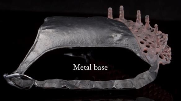 Upper metal base partial denture/occlusal stabilisation splint/obturator - full protocol