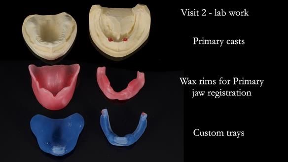 Newsletter 78: What do Clark Gable and a Locator® overdenture have in common?