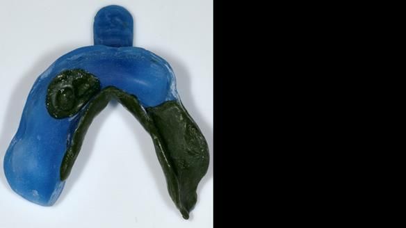 Newsletter 86 Peter the Architect — precision removable partial dentures case study