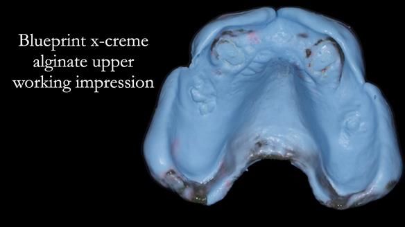 Newsletter 77: Jeremy’s case – immediate complete upper denture
