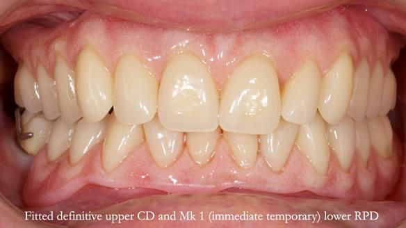 Newsletter 82 Mary - A complete upper and a one-tooth gasket denture