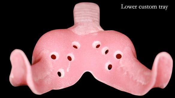 Newsletter 52 Managing Jo’s failing dentition with extractions and Mk 1/Mk 2 complete upper dentures and lower partial dentures FULL PROTOCOL