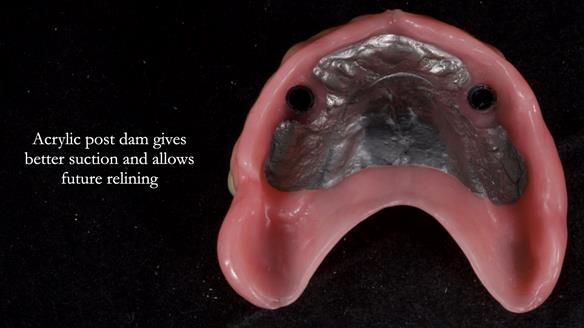 Newsletter 57 showcases the making and fitting process of implant-supported complete dentures for Alisdair