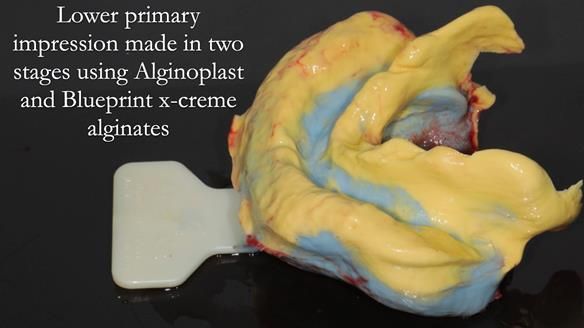 Finlay's Newsletter 62 provision of extractions and metal based complete dentures for Rafique