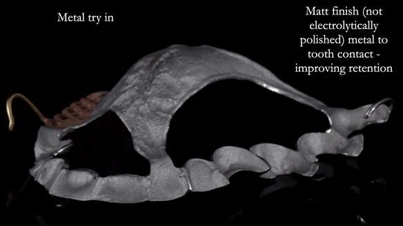 Finlay's Newsletter 64 case study - provision of a Kennedy class 2 metal based Scandinavian RPD for Ian