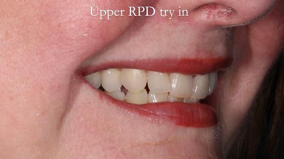 Finlay's Newsletter 58 Gasket upper partial denture for Zoe