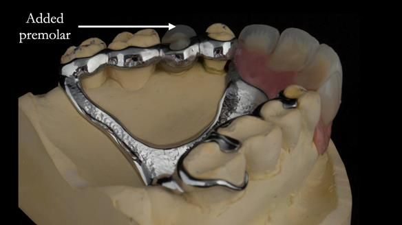 Finlay's Newsletter 63 Case study provision of metal based Scandinavian RPD - functional 10 years on