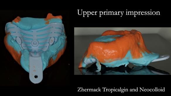 Syringe light bodied alginate into the sulcus from hamular notch round to hamular notch. The heavy bodied alginate is carried in a Schottlander Edentulous tray.