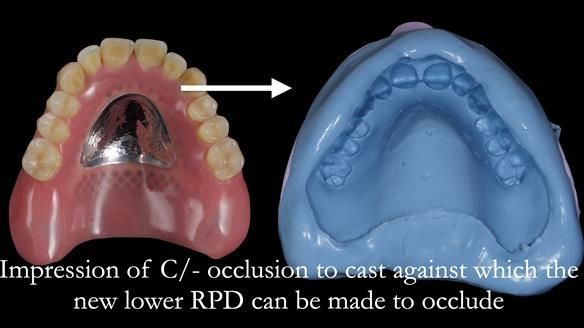 Newsletter 54 case presentation upper complete denture and lower Scandinavian designed hygienic partial denture for David