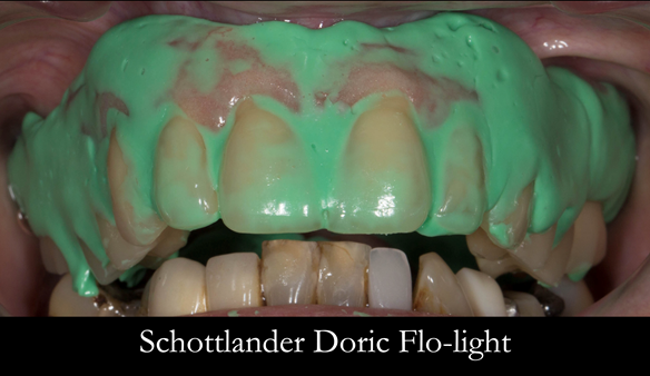 Figure 51 Light bodied silicone impression material used for the reline. This is placed firmly in the mouth seating fully in the palate and border moulded as per a definitive impression. The impression is made without the patient occluding. I find I have