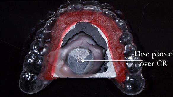 Newsletter 44 - extreme removable prosthodontics – engineering a super-strong and ultra-thin over denture