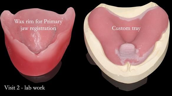 Newsletter 54 case presentation upper complete denture and lower Scandinavian designed hygienic partial denture for David