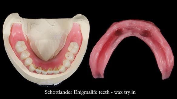 Newsletter 78: What do Clark Gable and a Locator® overdenture have in common?