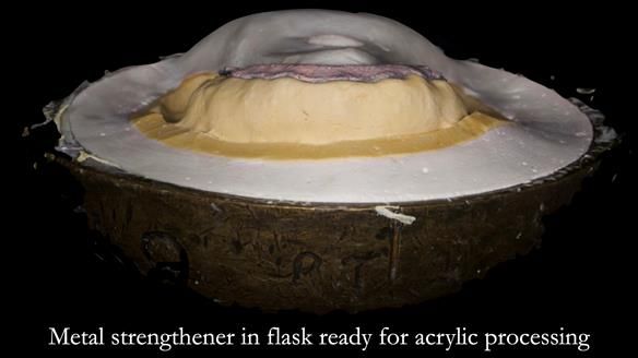 Managing poor implant positioning with complete dentures and Locator attachments - full protocol Newsletter 41