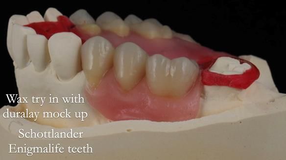 Finlay's Newsletter 60 Sylvia's upper Kennedy Class 2 Mod 1 metal based upper RPD