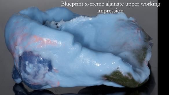 Newsletter 55 Provision of metal based partial dentures for Zephyrine with a repaired cleft lip and palate