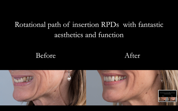 Figure 86 Before and after photos with cobalt chromium based partial dentures with Schottlander Enigmalife teeth