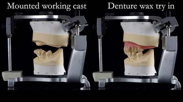 Newsletter 54 case presentation upper complete denture and lower Scandinavian designed hygienic partial denture for David
