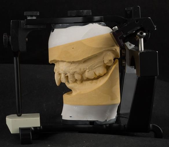 Figure 20 Cast for making the immediate complete denture with full depth of the sulcus recorded mounted in intercuspal position for Mk 1 denture. Mk 2 denture was made to centric relation using central bearing appliance