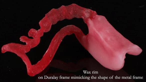 Finlay's Newsletter 61 provision of a lower unilateral free end saddle metal based partial denture for Joyce