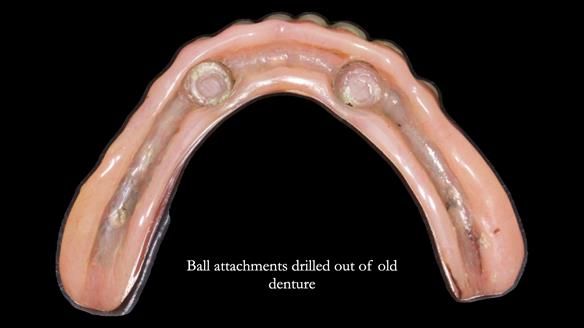 Newsletter 78: What do Clark Gable and a Locator® overdenture have in common?