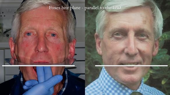 Newsletter 77: Jeremy’s case – immediate complete upper denture