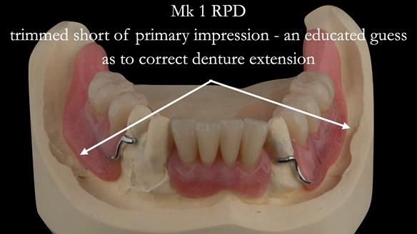 Finlay's Case Study Newsletter 40 - Immediate Mk 1 RPD to Definitive Mk 2 RPD - full protocol