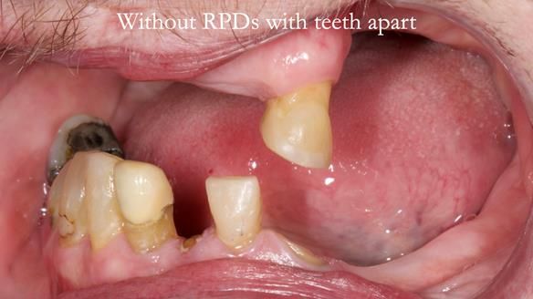 Newsletter 55 Provision of metal based partial dentures for Zephyrine with a repaired cleft lip and palate