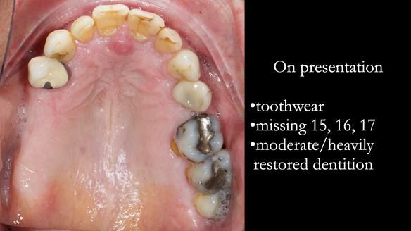 Finlay's Newsletter 64 case study - provision of a Kennedy class 2 metal based Scandinavian RPD for Ian