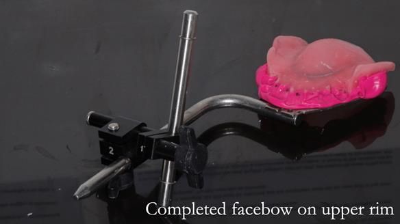 Newsletter 56 showing the making and fitting of a bilateral free end saddle upper removable partial denture (RPD) for patient with pemphigus