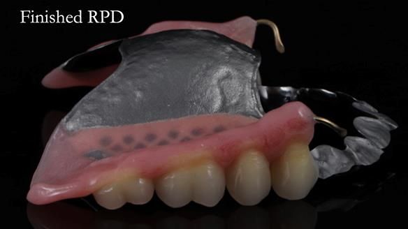 Newsletter 56 showing the making and fitting of a bilateral free end saddle upper removable partial denture (RPD) for patient with pemphigus