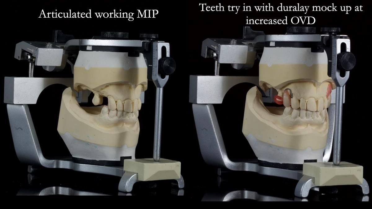 Newsletter 89 – Simon: A Challenging Kennedy Class II Division 1 Upper CoCr Partial Denture with a High Smile Line