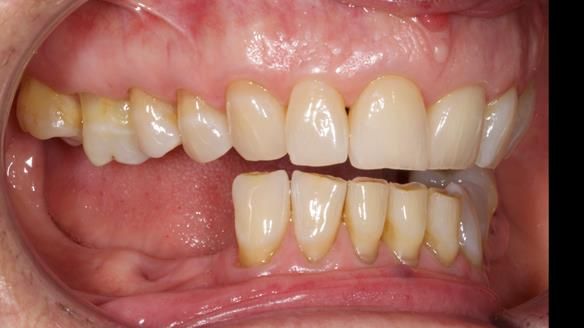 Finlay's Newsletter 61 provision of a lower unilateral free end saddle metal based partial denture for Joyce