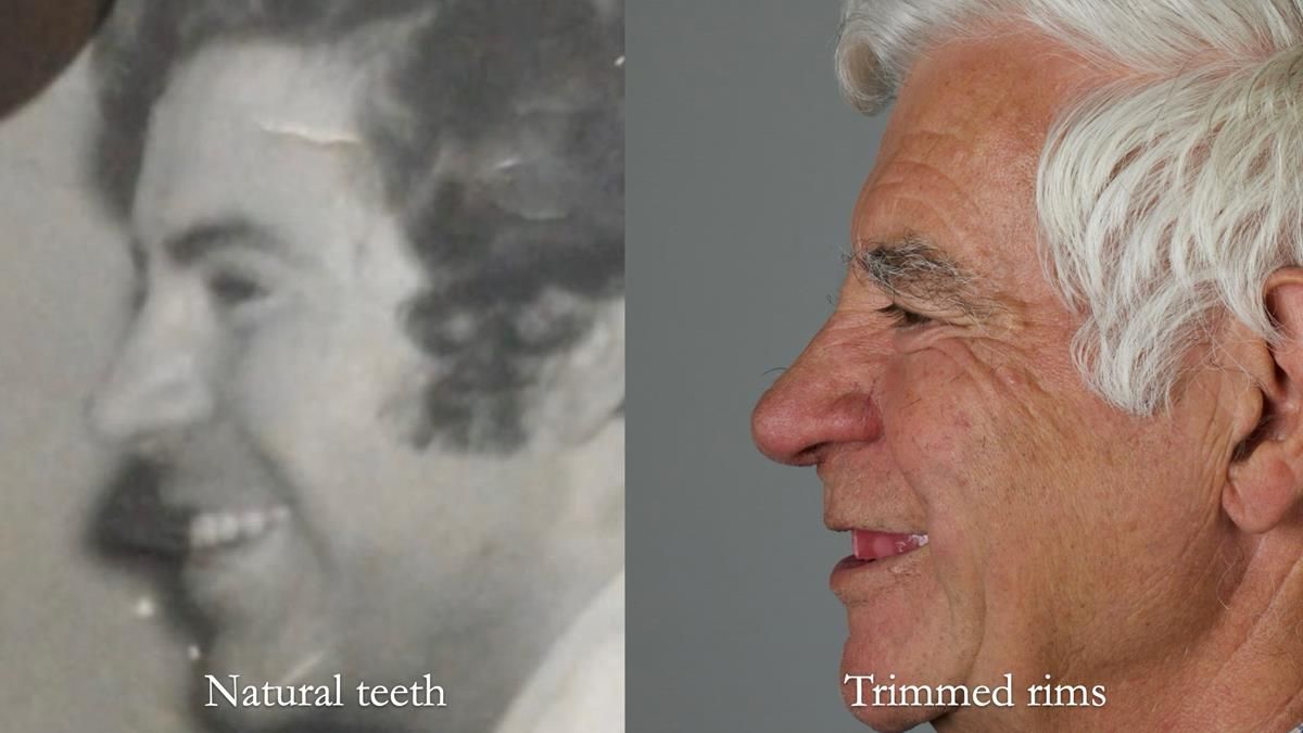 Fin’s Newsletter 88 — Complete dentures - full protocol… he rearranged his own teeth!