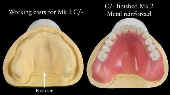 Newsletter 52 Managing Jo’s failing dentition with extractions and Mk 1/Mk 2 complete upper dentures and lower partial dentures FULL PROTOCOL