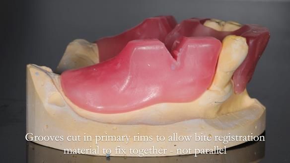 Finlay's Newsletter 59 Ultra hard partial dentures made for Gill