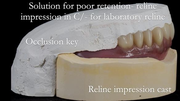Newsletter 53 showing the making and fitting of ultra life-like dentures for Valena