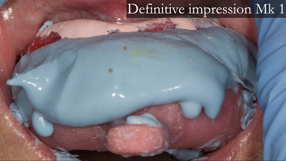 Figure 19 Over impression in alginate to record the teeth using over tray