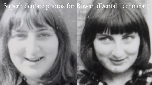 Newsletter 55 Provision of metal based partial dentures for Zephyrine with a repaired cleft lip and palate