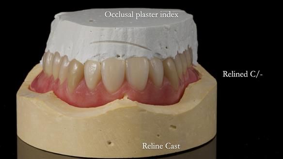 Newsletter 77: Jeremy’s case – immediate complete upper denture