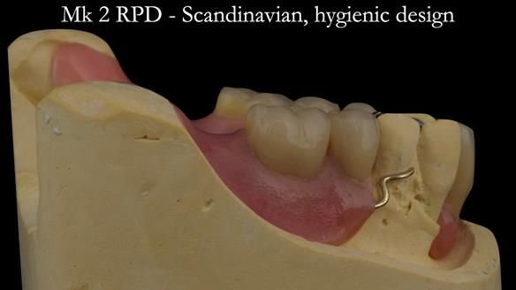 Finlay's Case Study Newsletter 40 - Immediate Mk 1 RPD to Definitive Mk 2 RPD - full protocol