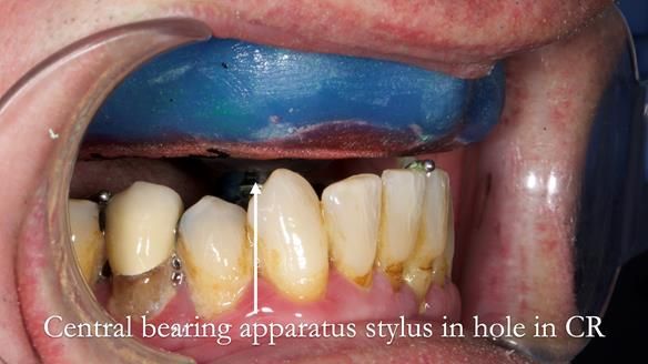 Newsletter 77: Jeremy’s case – immediate complete upper denture