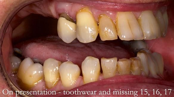 Finlay's Newsletter 64 case study - provision of a Kennedy class 2 metal based Scandinavian RPD for Ian