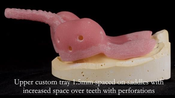 Finlay's Newsletter 59 Ultra hard partial dentures made for Gill