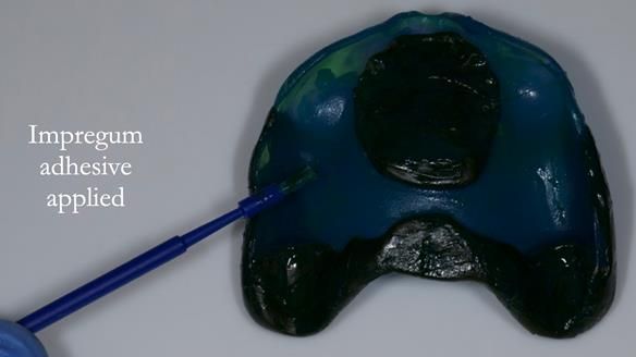 Newsletter 57 showcases the making and fitting process of implant-supported complete dentures for Alisdair