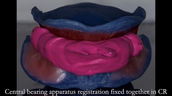 Newsletter 83: Sheila’s Complete Denture Success