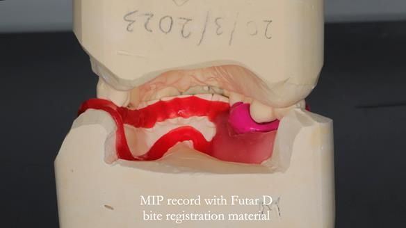 Finlay's Newsletter 61 provision of a lower unilateral free end saddle metal based partial denture for Joyce