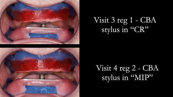 Newsletter 80 - Gordon’s dentures: the one case in 1,000 where my technique failed